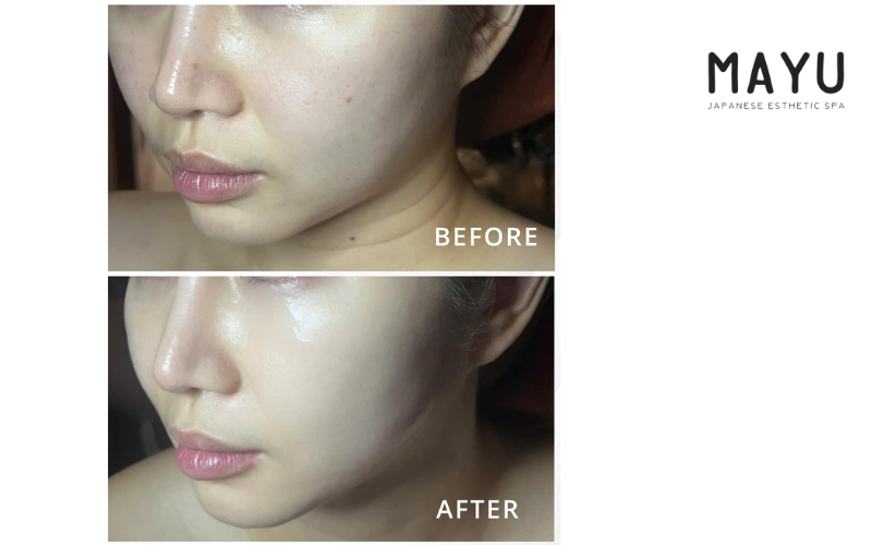 Phương pháp Juvelook chỉ thấy được hiệu quả rõ rệt từ sau 2-3 tháng