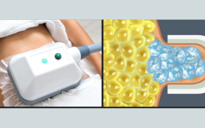 Công nghệ giảm béo bằng phương pháp đông huỷ mỡ được nhiều khách hàng ưa chuộng