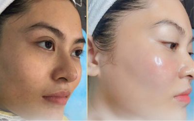 so-sanh-giua-tiem-meso-va-tiem-bap-1