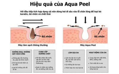 aqua peel là gì_4