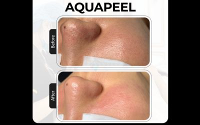 aqua peel là gì_6
