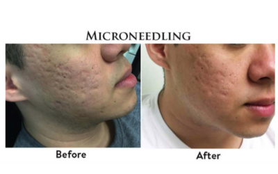 microneedle-la-gi-2