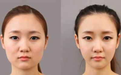 sở hữu mặt Vline không cần dao kéo_4