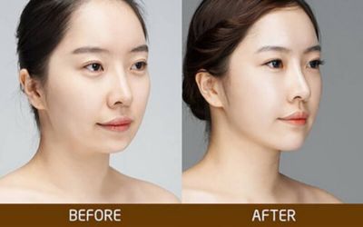 sở hữu mặt Vline không cần dao kéo_7
