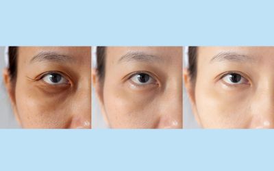 Khách hàng chia sẻ về làn da căng bóng, mịn màng chỉ sau một liệu trình tiêm BAP Profhilo tại Mayu Japanese Esthetic Spa. Không chỉ an tâm với tay nghề chuyên gia, họ còn hài lòng bởi không gian spa chuẩn Nhật, nhẹ nhàng, thư giãnKhách hàng chia sẻ về làn da căng bóng, mịn màng chỉ sau một liệu trình tiêm BAP Profhilo tại Mayu Japanese Esthetic Spa. Không chỉ an tâm với tay nghề chuyên gia, họ còn hài lòng bởi không gian spa chuẩn Nhật, nhẹ nhàng, thư giãn