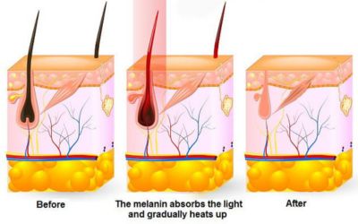 triệt lông ipl và shr_2