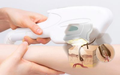 triệt lông ipl và shr_3