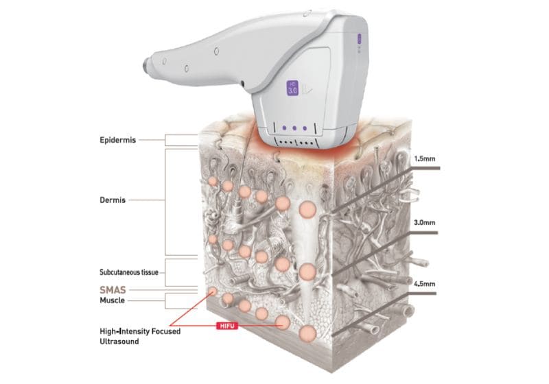HIFU được xem là bí quyết nâng cơ không dao kéo, trẻ hóa làn da từ sâu bên trong