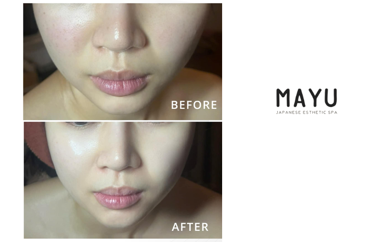 Sự cải thiện rõ rệt của khách hàng tại Mayu Spa làm liệu trình Hifu nâng cơ mặt
