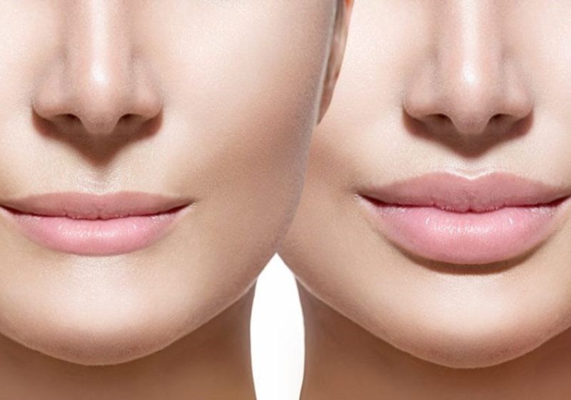 teoxane-rha-1-va-teoxane-rha-2