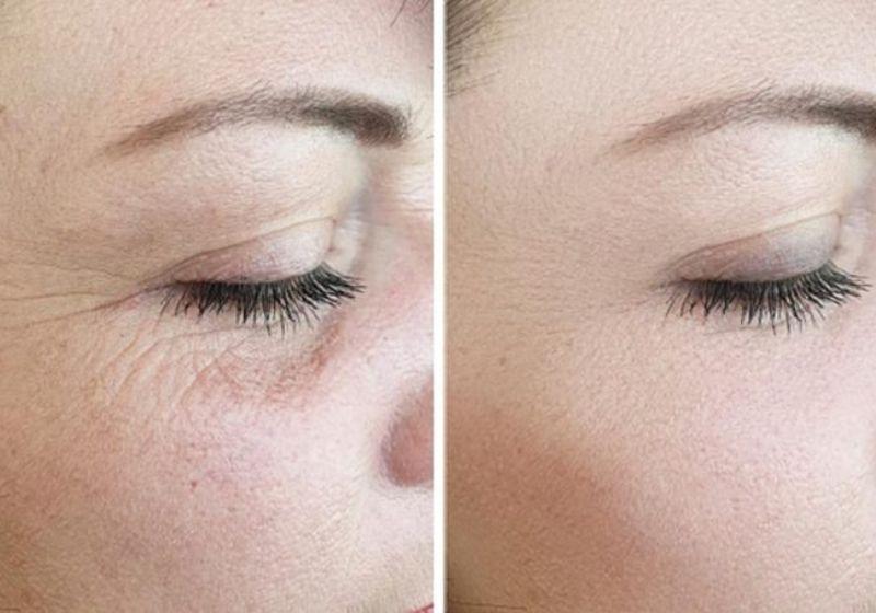 Chị Chi - Liệu trình Rejuran I