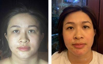 Skin visibly improved after undergoing Karisma injections at Mayu Esthetic Spa.