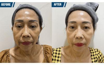 Before & After Profhilo Injections – Image 1