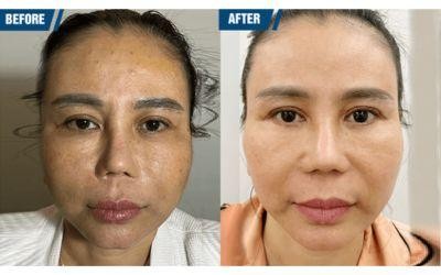 Before & After Profhilo Injections – Image 2