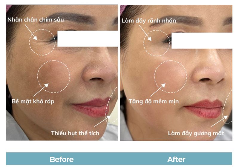 Before and after photos of clients who received Karisma injections.